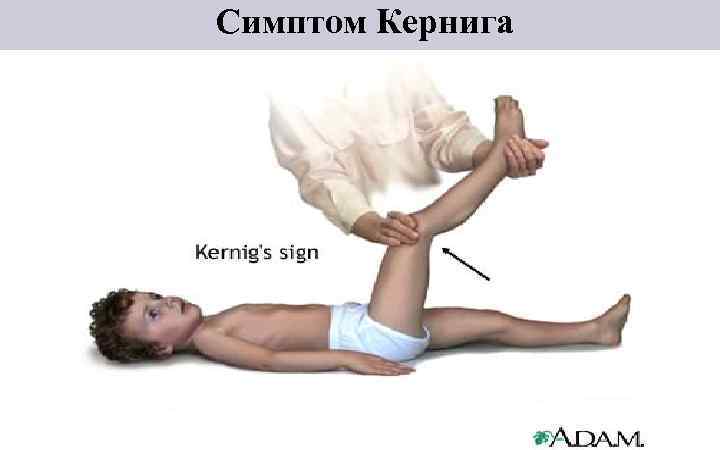 Симптом Кернига 