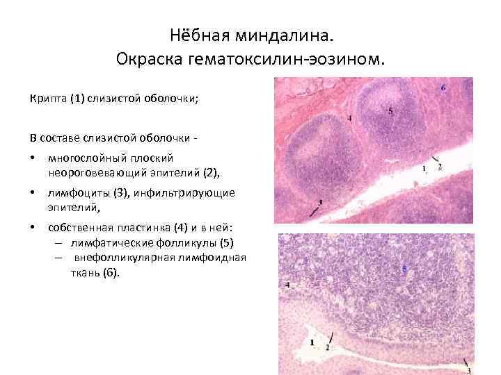 Нёбная миндалина. Окраска гематоксилин-эозином. Крипта (1) слизистой оболочки; В составе слизистой оболочки - •