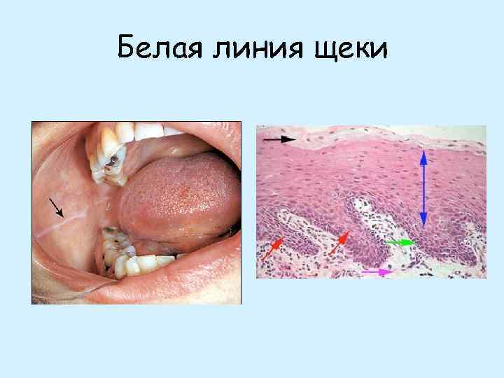 Белая линия щеки 