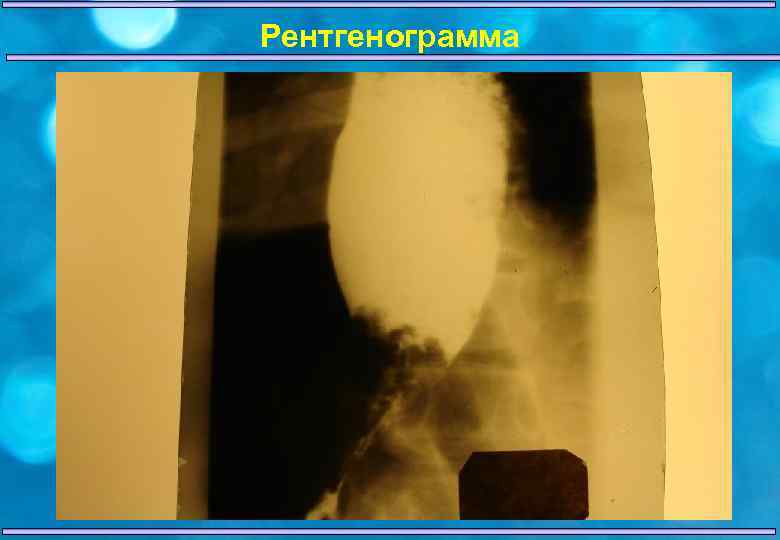 Рентгенограмма 