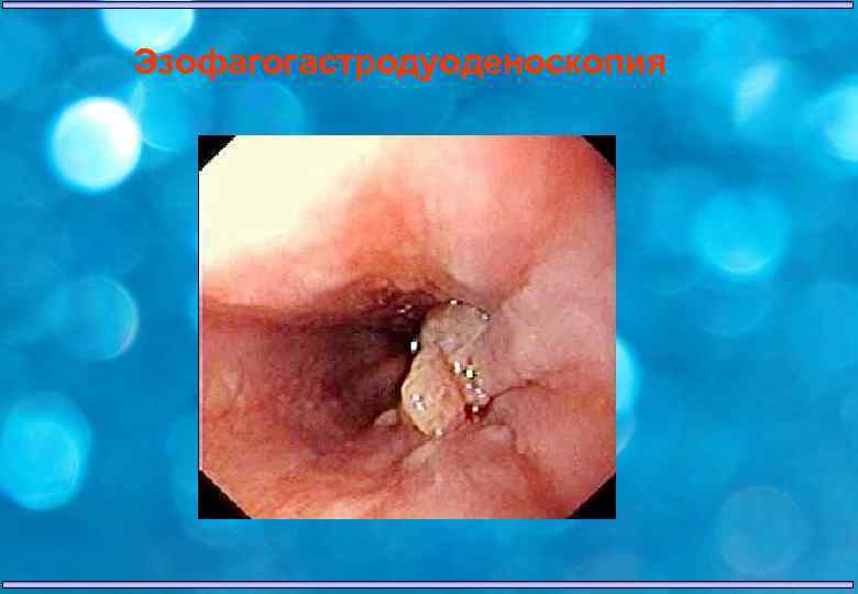 Эзофагогастродуоденоскопия 