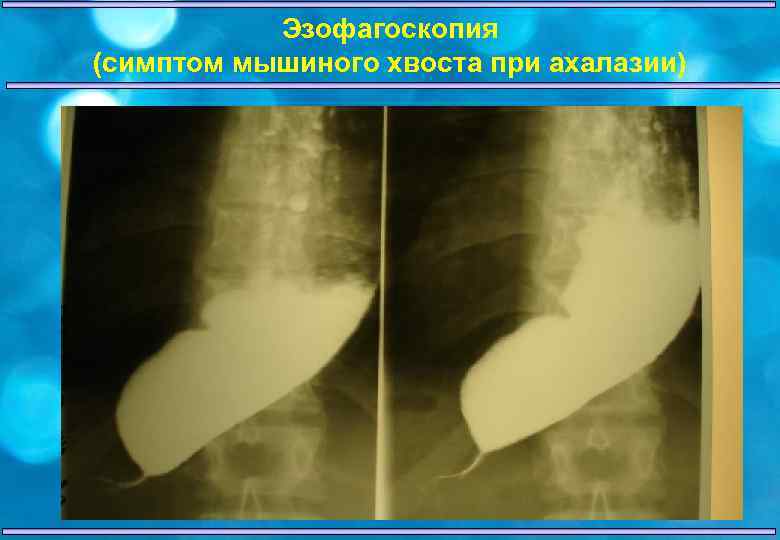 Эзофагоскопия (симптом мышиного хвоста при ахалазии) 