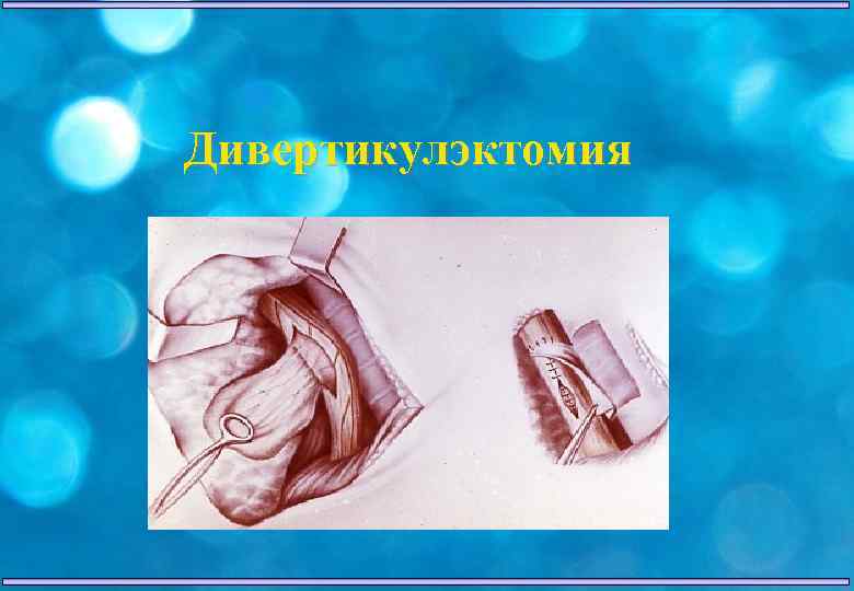 Дивертикулэктомия 