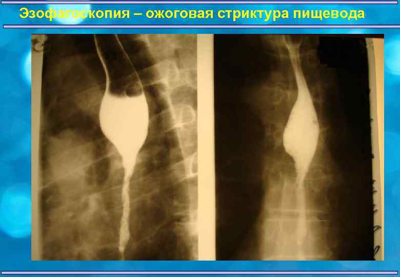 Эзофагоскопия – ожоговая стриктура пищевода 