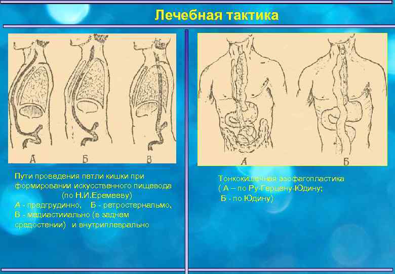 Заболевания пищевода госпитальная хирургия презентация