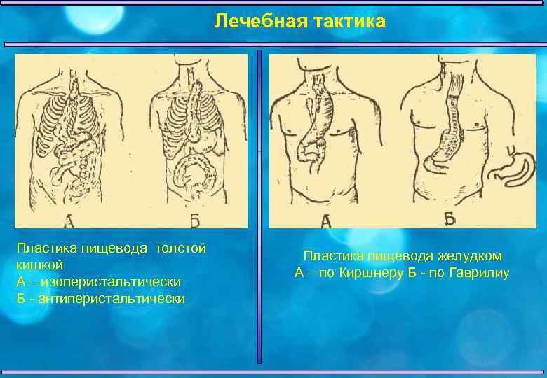 Заболевания пищевода хирургия презентация