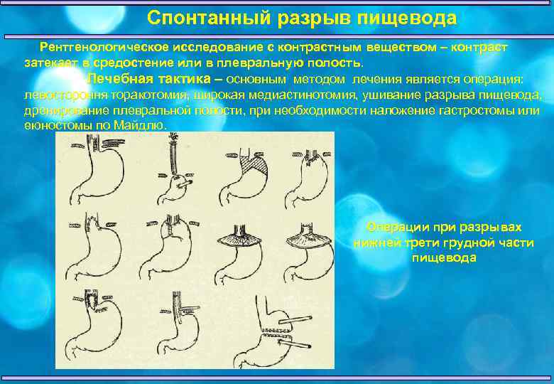 Разрыв пищевода причины