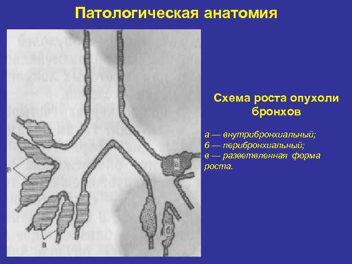 Патологическая анатомия Схема роста опухоли бронхов а — внутрибронхиальный; 6 — перибронхиальный; в —