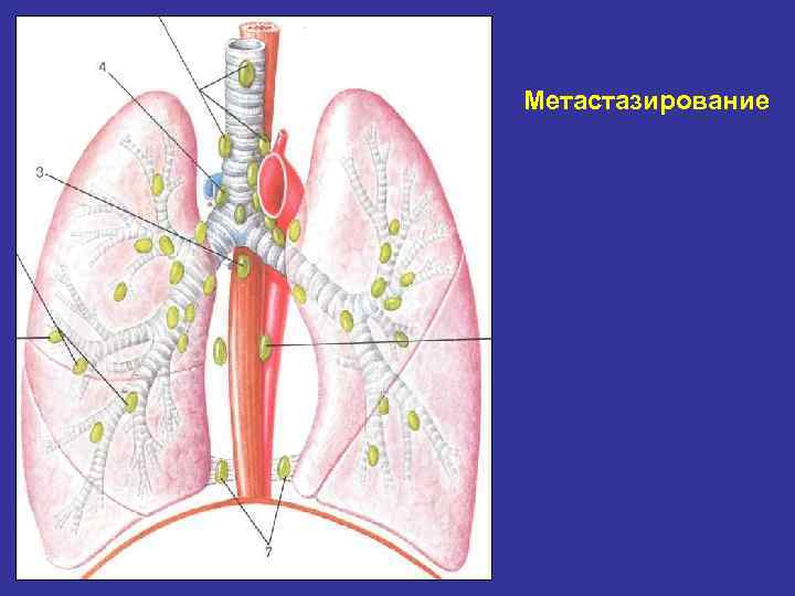 Метастазирование 