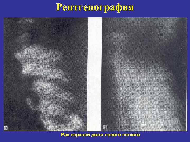 Рентгенография Рак верхней доли левого легкого 