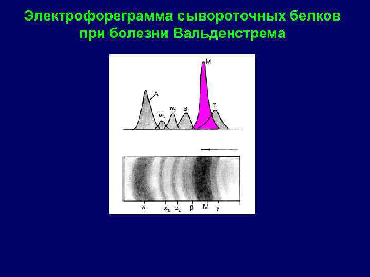 Электрофореграмма сывороточных белков при болезни Вальденстрема 
