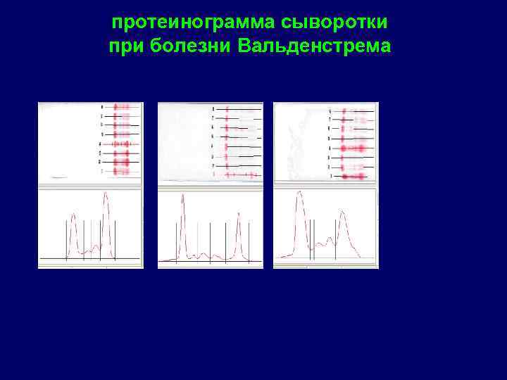 протеинограмма сыворотки при болезни Вальденстрема 