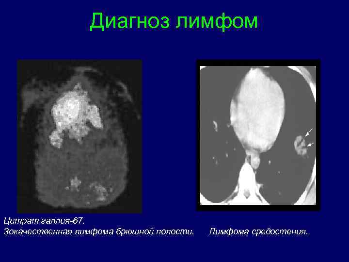Диагноз лимфом Цитрат галлия-67. Зокачественная лимфома брюшной полости. Лимфома средостения. 