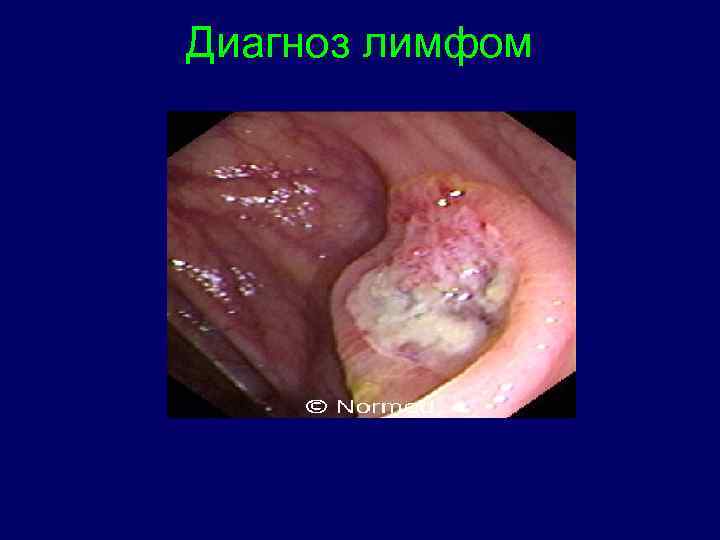 Диагноз лимфом 