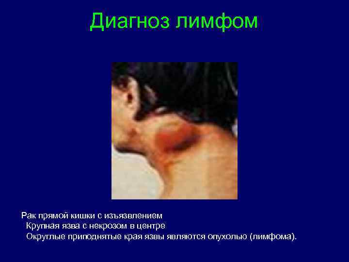 Диагноз лимфом Рак прямой кишки с изъязвлением Крупная язва с некрозом в центре Округлые