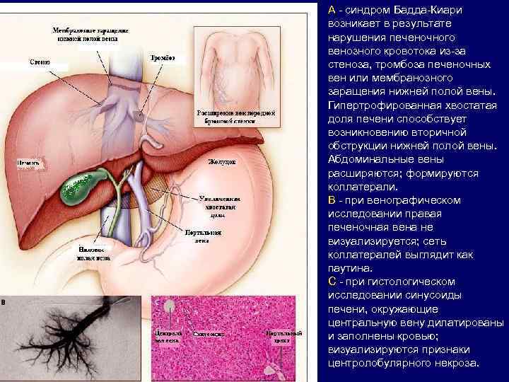 А - синдром Бадда-Киари возникает в результате нарушения печеночного венозного кровотока из-за стеноза, тромбоза