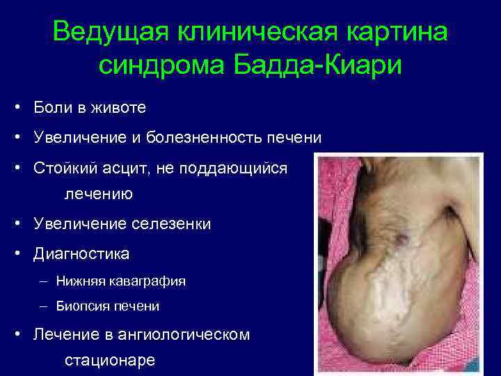 Ведущая клиническая картина синдрома Бадда-Киари • Боли в животе • Увеличение и болезненность печени