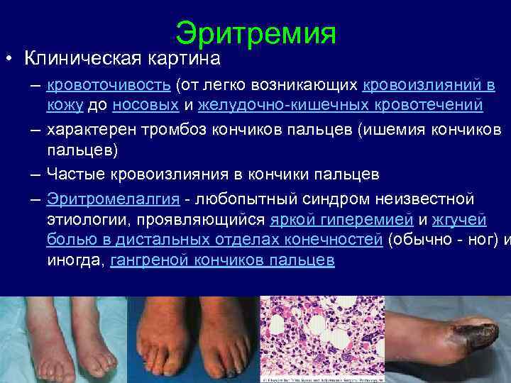 Эритремия • Клиническая картина – кровоточивость (от легко возникающих кровоизлияний в кожу до носовых