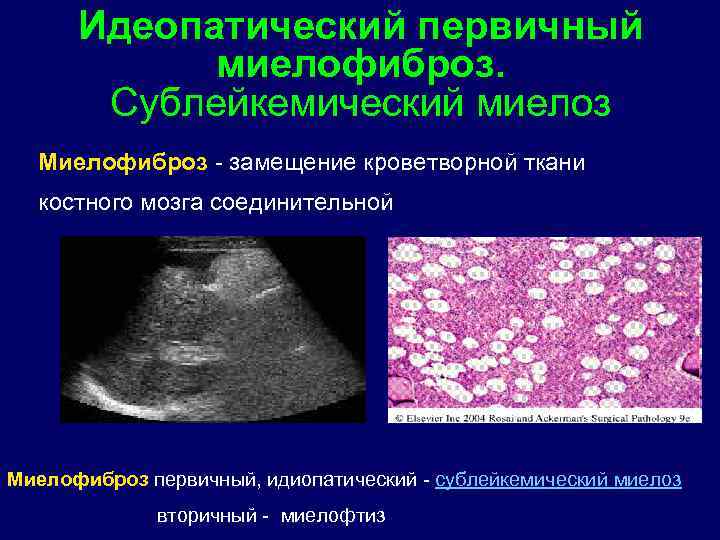 Идеопатический первичный миелофиброз. Сублейкемический миелоз Миелофиброз - замещение кроветворной ткани костного мозга соединительной Миелофиброз
