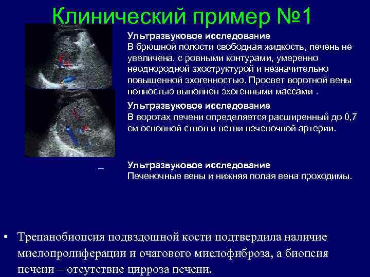Клинический пример № 1 Ультразвуковое исследование В брюшной полости свободная жидкость, печень не увеличена,