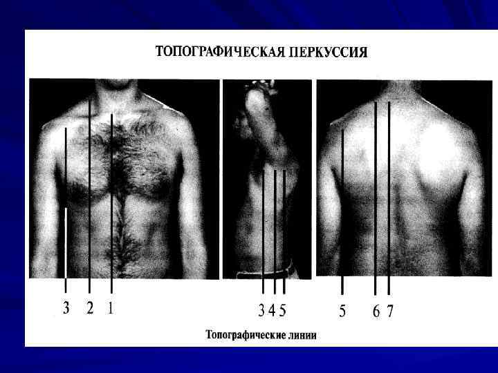 Перкуссия легких сравнительная и топографическая. Топографическая перкуссия легких. Линии топографической перкуссии. Сравнительная и топографическая перкуссия.