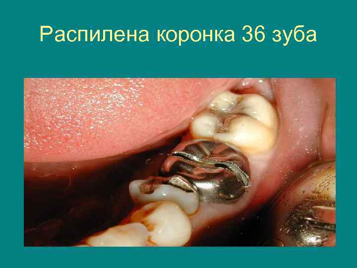 Распилена коронка 36 зуба 