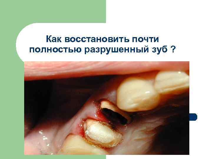 Как восстановить почти полностью разрушенный зуб ? 