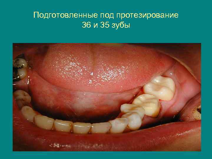 Подготовленные под протезирование 36 и 35 зубы 