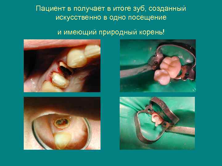 Пациент в получает в итоге зуб, созданный искусственно в одно посещение и имеющий природный