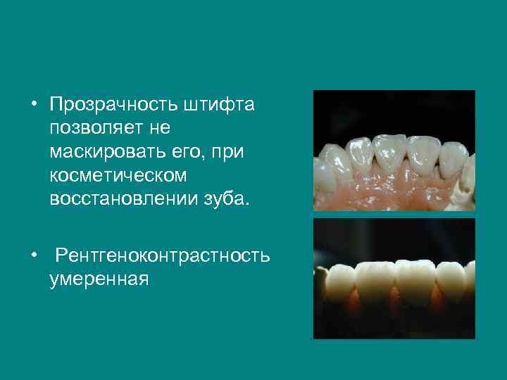  • Прозрачность штифта позволяет не маскировать его, при косметическом восстановлении зуба. • Рентгеноконтрастность