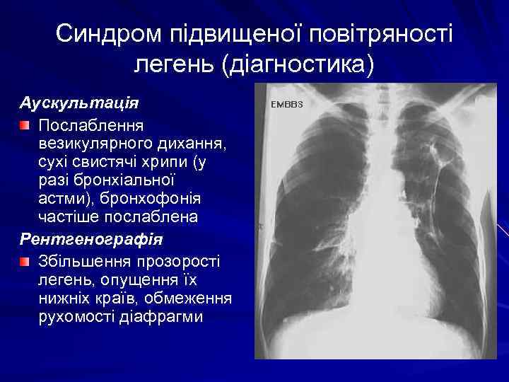 Синдром підвищеної повітряності легень (діагностика) Аускультація Послаблення везикулярного дихання, сухі свистячі хрипи (у разі
