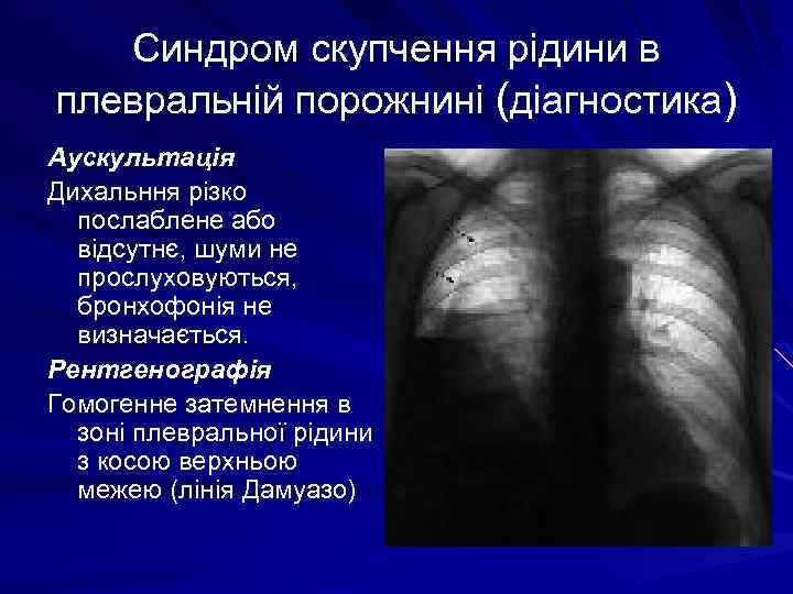 Синдром скупчення рідини в плевральній порожнині (діагностика) Аускультація Дихальння різко послаблене або відсутнє, шуми