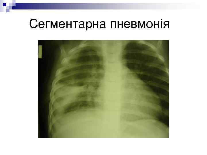 Сегментарна пневмонія 