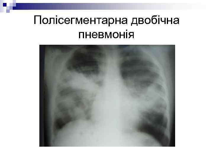 Полісегментарна двобічна пневмонія 