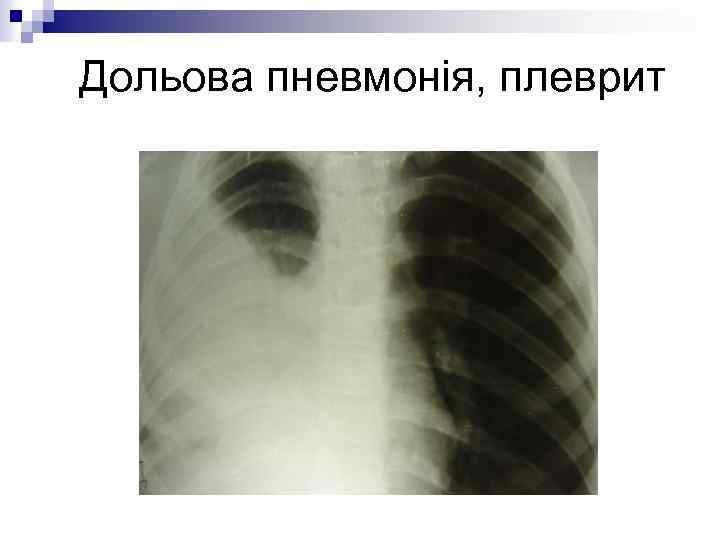 Дольова пневмонія, плеврит 