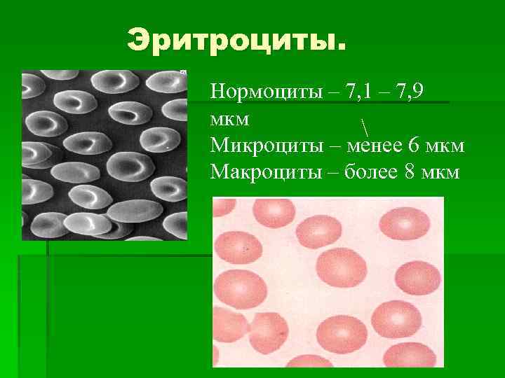 Макроциты. Нормоциты. Нормоциты в крови. Нормоциты микроциты макроциты. Оксифильный нормоцит.