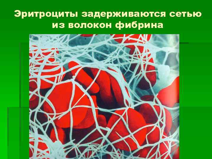 Эритроциты задерживаются сетью из волокон фибрина 