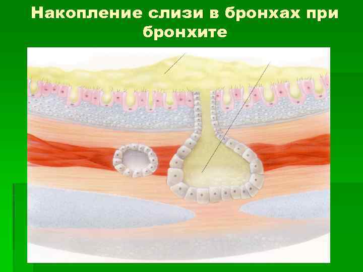 Накопление слизи в бронхах при бронхите 
