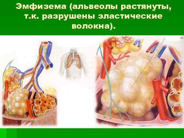 Эмфизема (альвеолы растянуты, т. к. разрушены эластические волокна). 