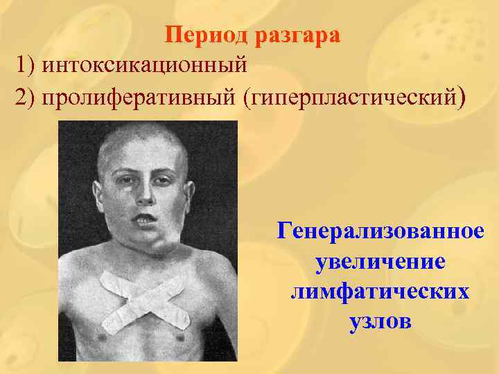 Период разгара 1) интоксикационный 2) пролиферативный (гиперпластический) Генерализованное увеличение лимфатических узлов 