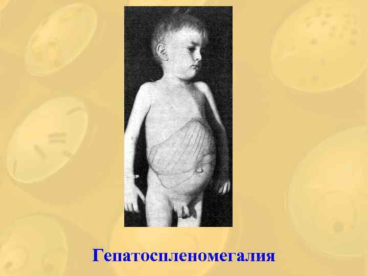 Гепатоспленомегалия 