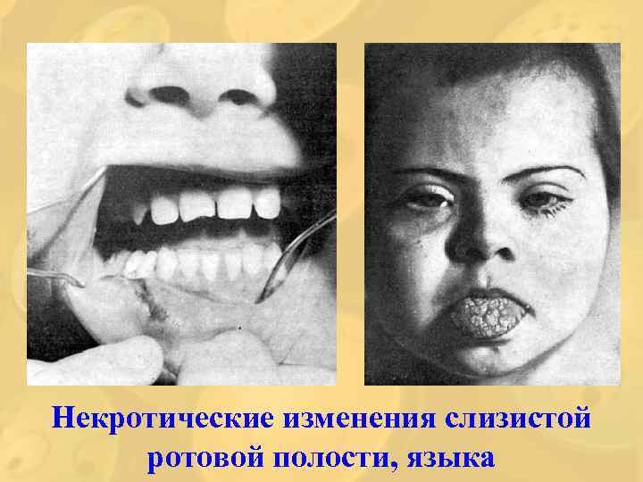 Некротические изменения слизистой ротовой полости, языка 