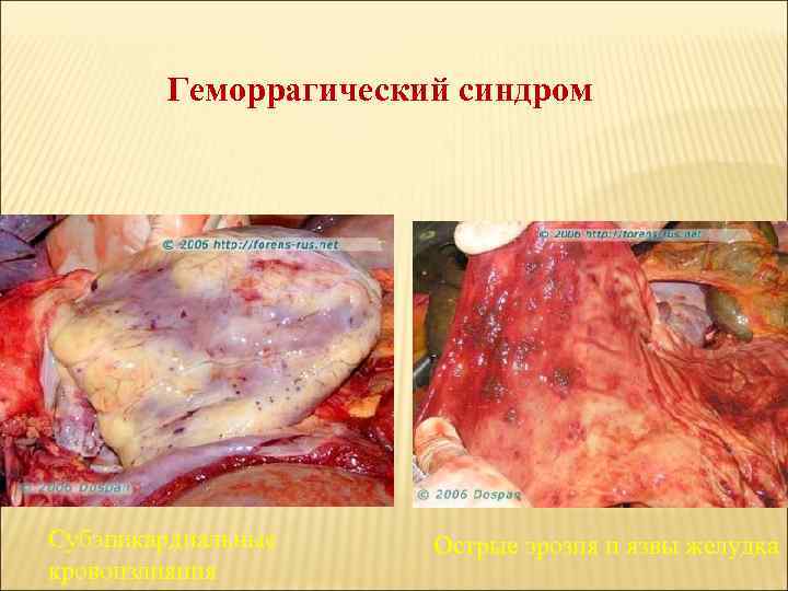 Геморрагический синдром Субэпикардиальные кровоизлияния Острые эрозия и язвы желудка 