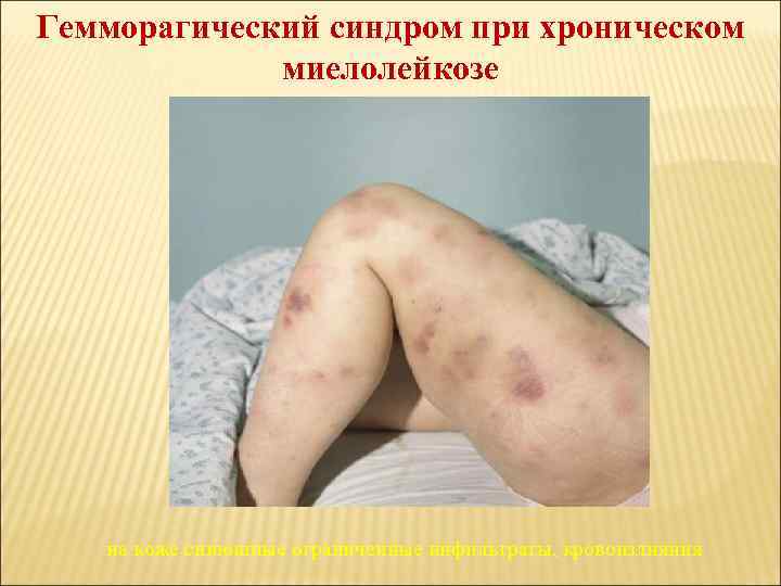 Гемморагический синдром при хроническом миелолейкозе на коже синюшные ограниченные инфильтраты, кровоизлияния 