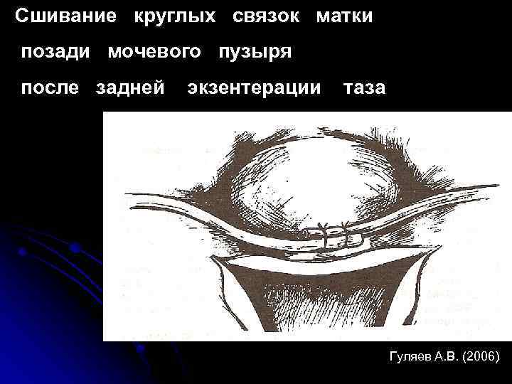 Сшивание круглых связок матки позади мочевого пузыря после задней экзентерации таза Гуляев А. В.