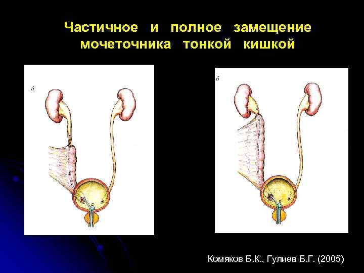 Частичное и полное замещение мочеточника тонкой кишкой Комяков Б. К. , Гулиев Б. Г.