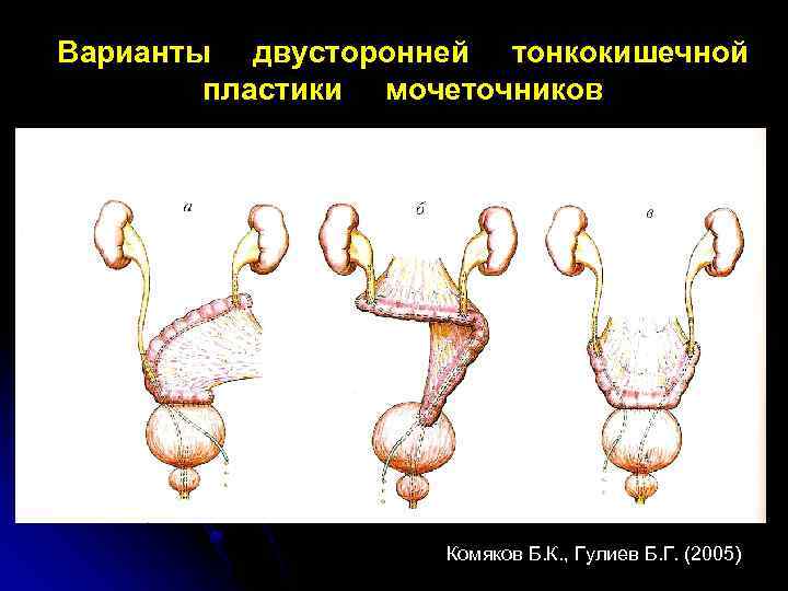 После пластики мочеточника