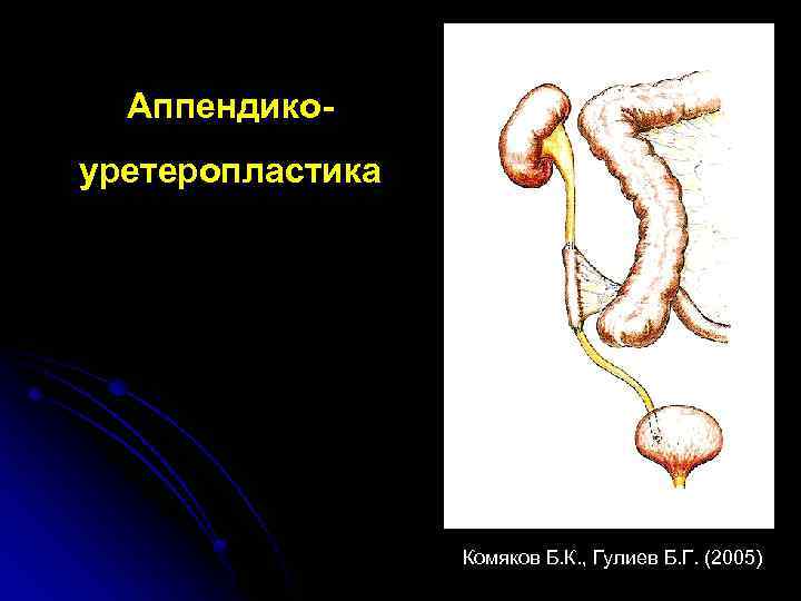 Аппендикоуретеропластика Комяков Б. К. , Гулиев Б. Г. (2005) 