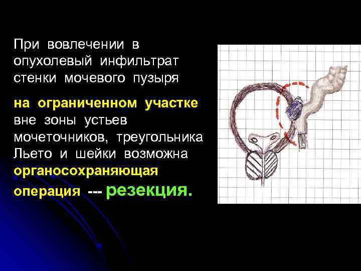 При вовлечении в опухолевый инфильтрат стенки мочевого пузыря на ограниченном участке вне зоны устьев