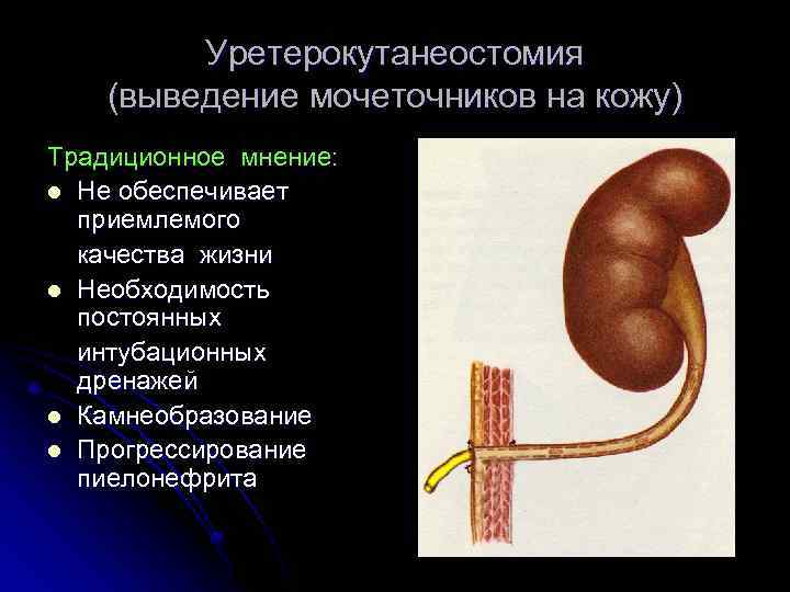 Уретерокутанеостомия (выведение мочеточников на кожу) Традиционное мнение: l Не обеспечивает приемлемого качества жизни l